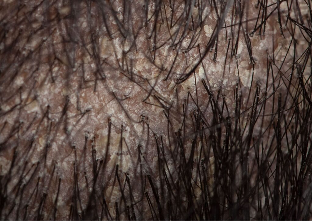 dermatitis cuero cabelludo