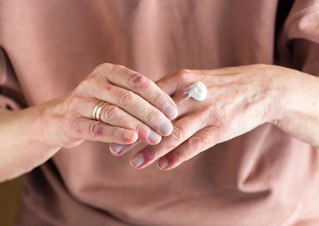 dermatitis manos qué hacer