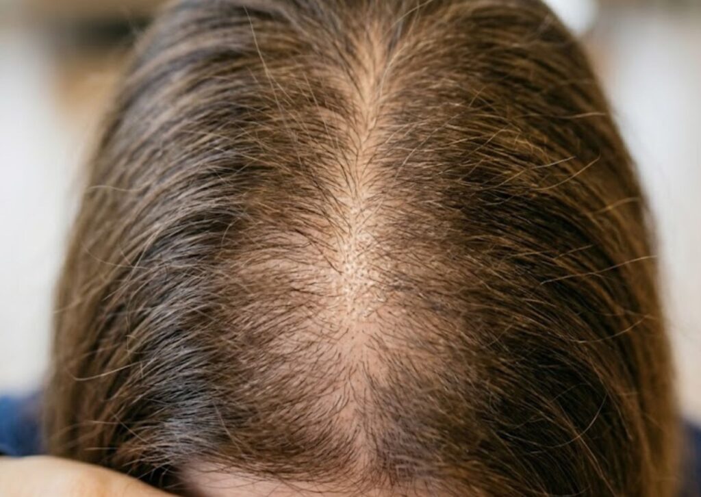alopecia androgenética femenina